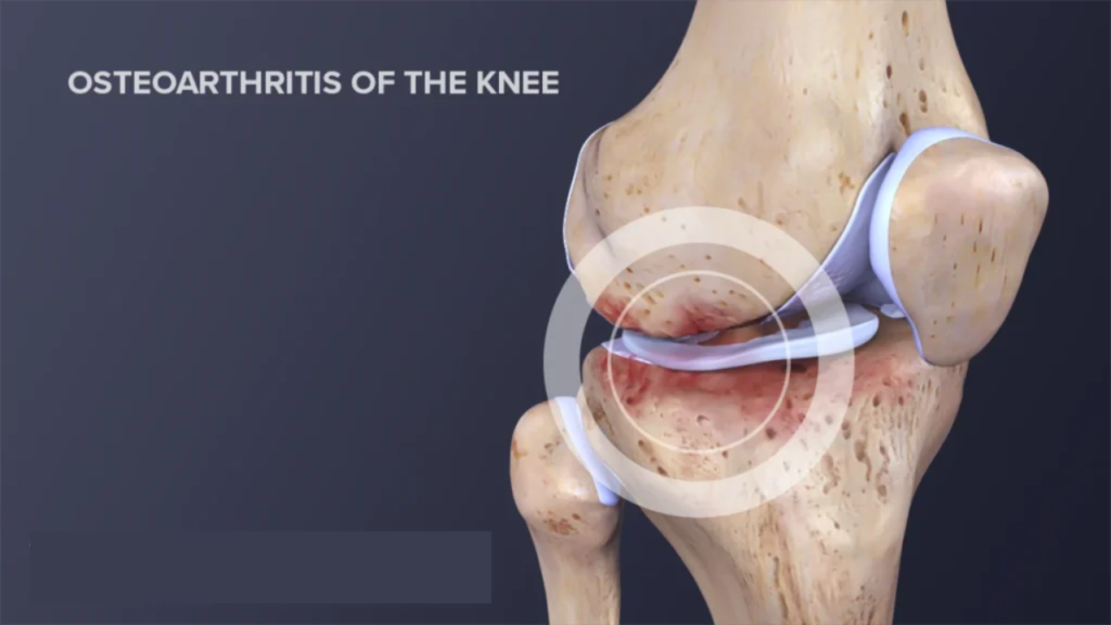 Revitalize Your Knee